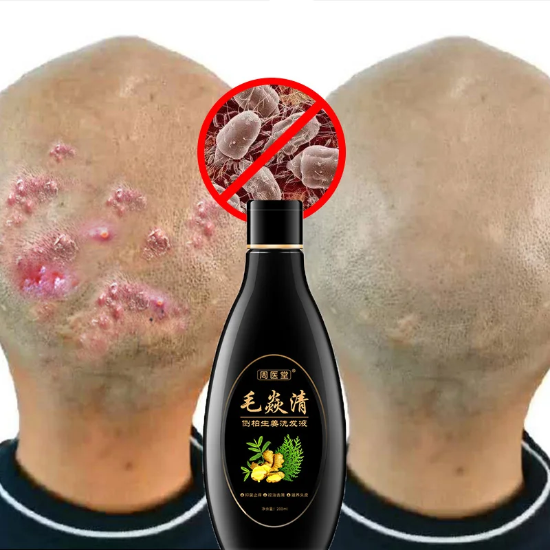 

Scalp Hair Follicle Shampoo Antibacterial Anti-itching Mites Oil Control Psoriasis and Scalp Cleansing Shampoo Skincare Product