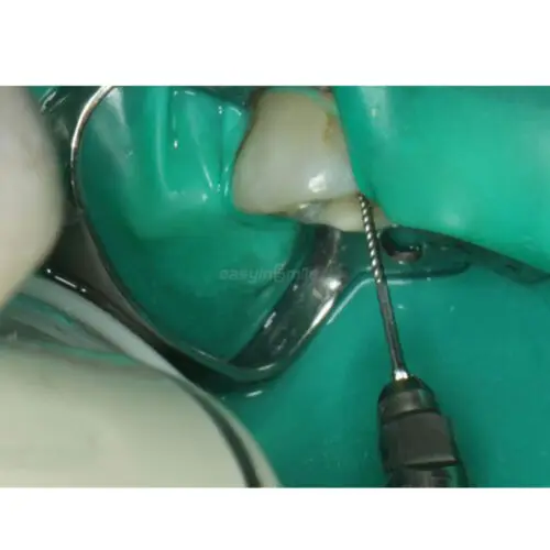 Рисунок 6 - EASYINSMILE Dental Endo U-File