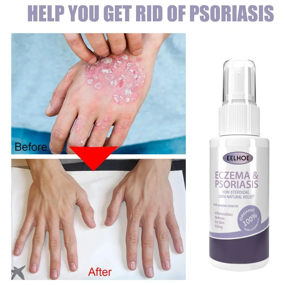 

Herbal Eczema Psoriasis Spray Antibacterial Dermatitis Athletes Foot Relieve Itching Irritation Allergies Lithospermum Skin Care