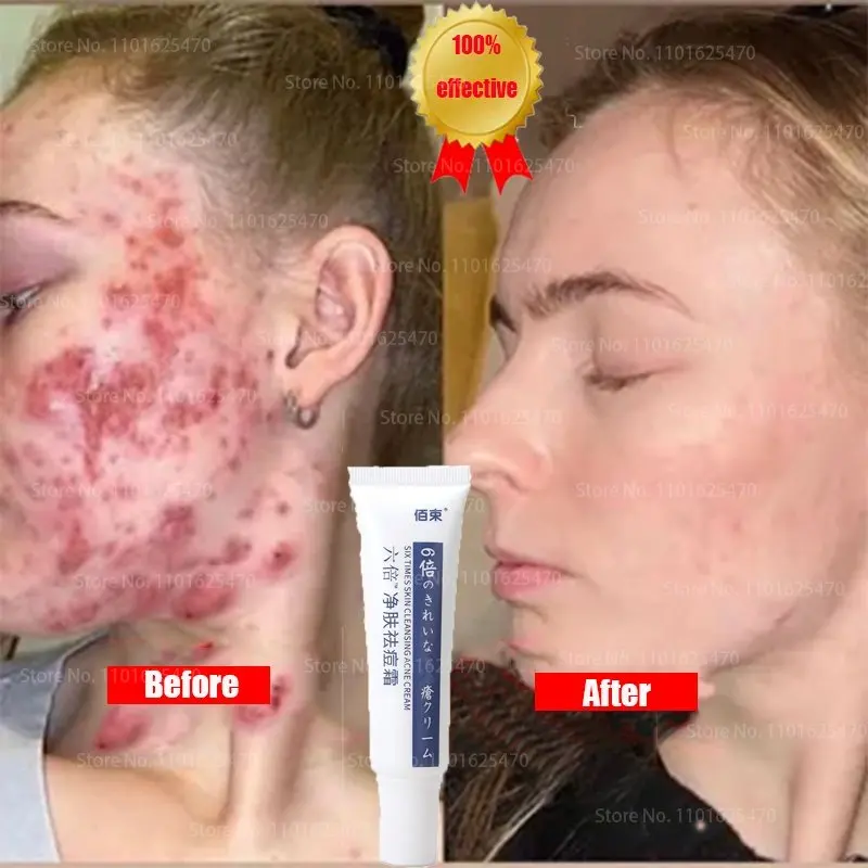 

Quick Acne Cream Acne Cream Acne Skin Care Products Get Rid of Acne Troubles and Restore Perfect Facial Skin Skin Whitening