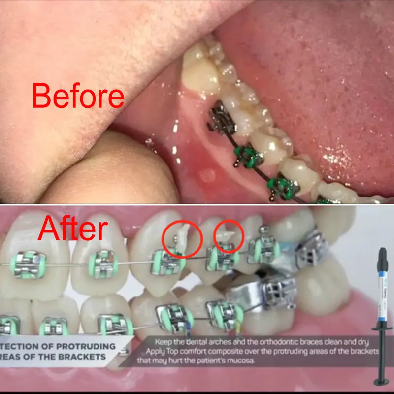 Высококачественный стоматологический временный заполняющий материал для