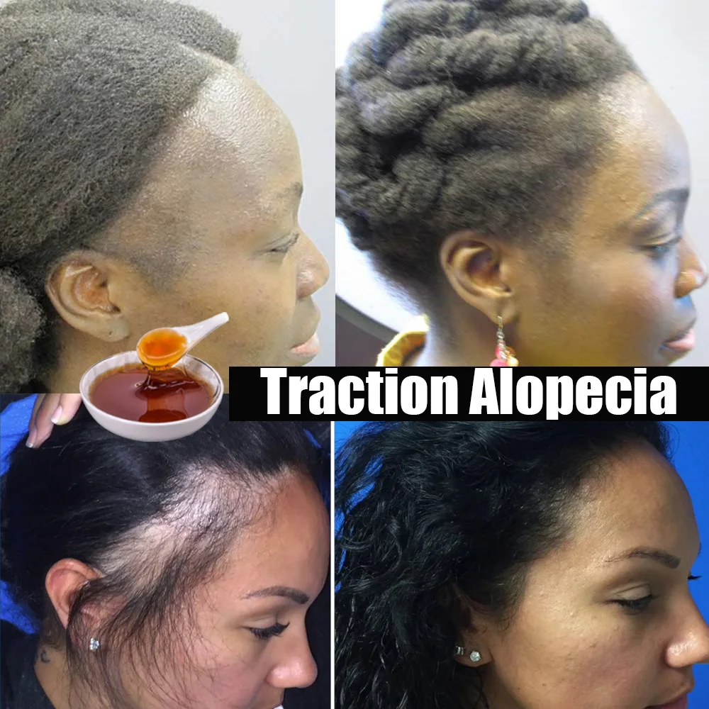 Chebe Powder Hair Loss Treatment Regrow your Edges Bald Spots Thinnin Hair Africa Crazy Hair Growth Products Traction Alopecia