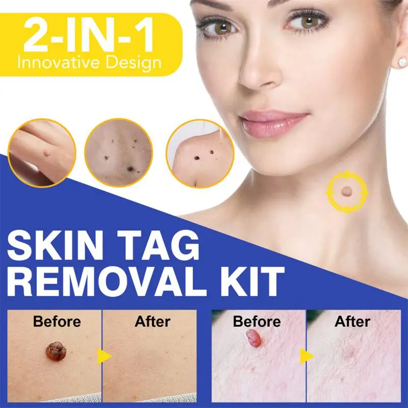 

2 In1 Wart Removing Tool Blue Set Skin Tag Removal Kit Home Use Mole Wart Remover Equipment Micro Skin Tag Treatment Tool