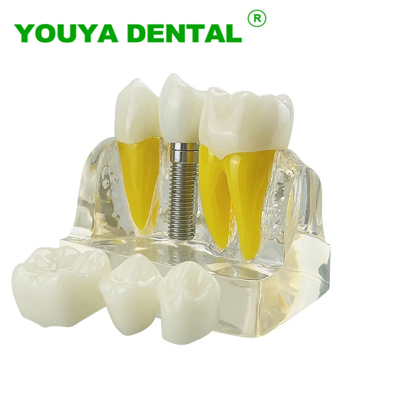 

4 Times Dental Teach Model Implant Analysis Crown Bridge Removable Model Dentistry Demonstration Model For Education Training