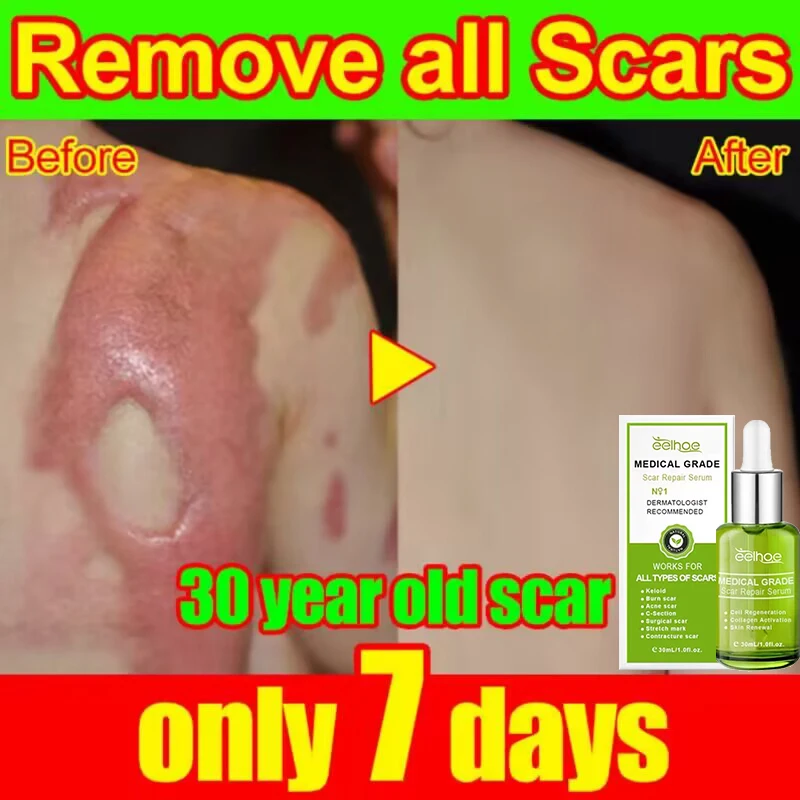 

Scar Removal Serum Remove Acne Spots Treatment Stretch Marks Burn Surgical Scar Repair Essence Smoothing Whitening Skin Beauty