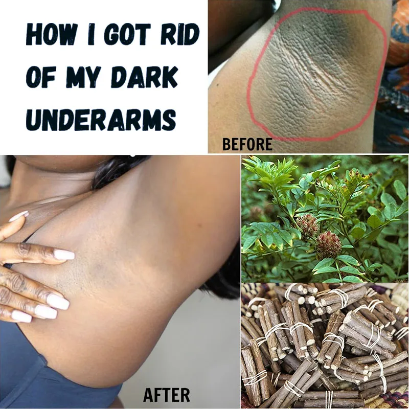 

Skin Lightening Product Solution for Dark Armpits Secret To Underarm Whitening Alpha Arbutin Hyperpigmentation Remover Even Tone