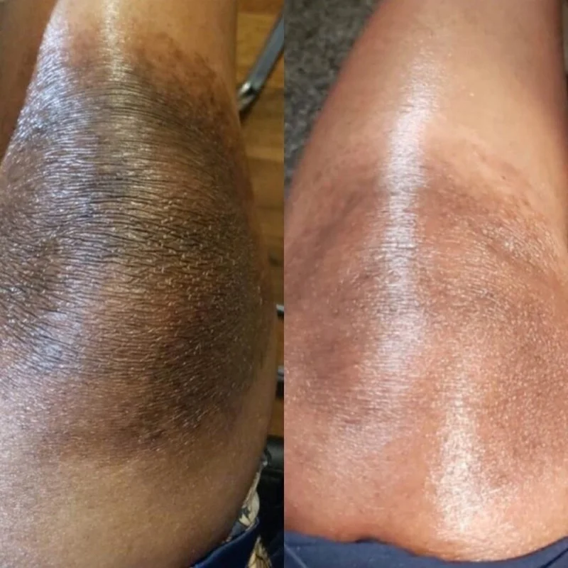 Отбеливание кожи на локтях. Как отбелить логти черные. Отбеливание кожи на локтях. Как отбелить логти черные. Отбеливание локтей до после.