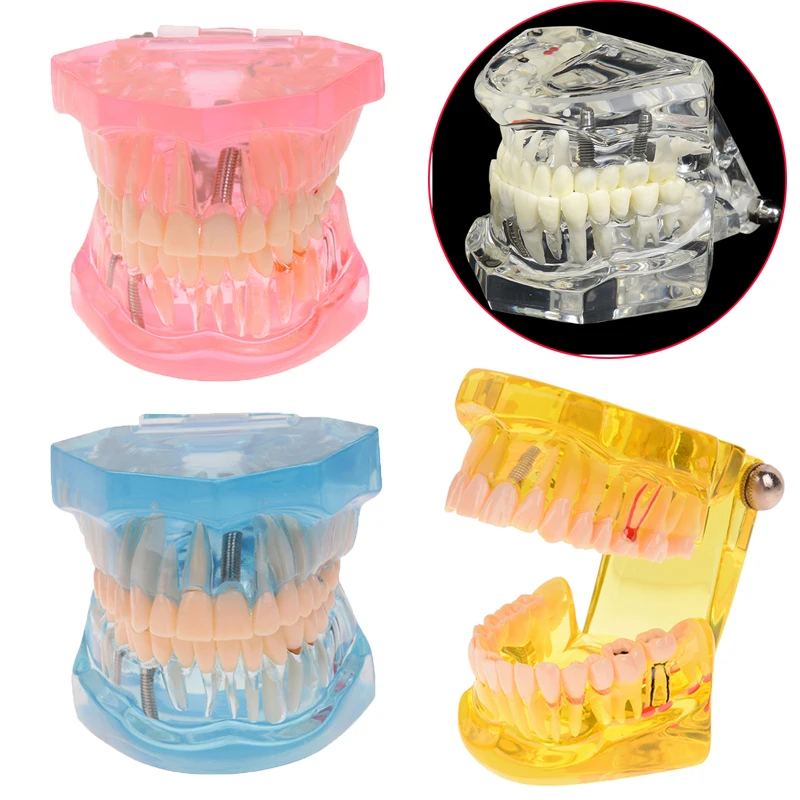 

1PC Disease Teeth Repair Model With Restoration Bridge Tooth Dentist For Medical Science Dental Teaching Study Dentistry Tools
