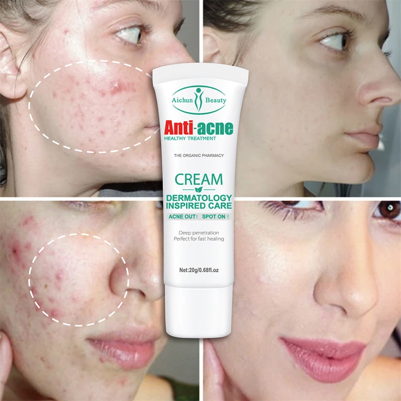 

Крем для удаления прыщей и шрамов от прыщей, 20 г