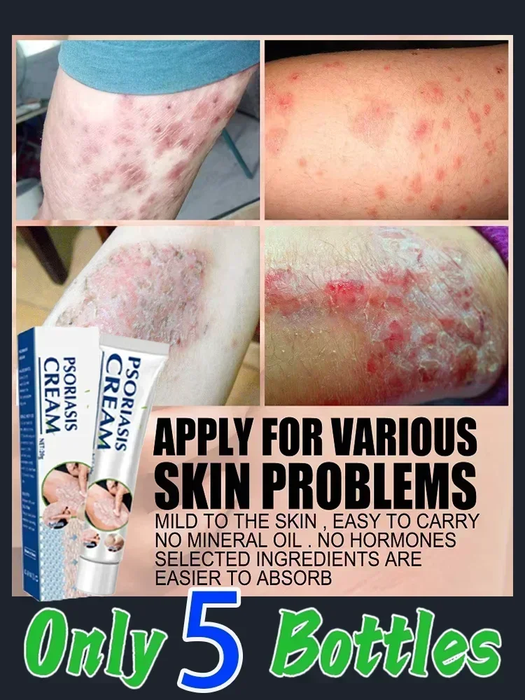 ГОРЯЧАЯ ПРОДАЖА натуральная травяная мазь от псориаза лечение дерматита экземы