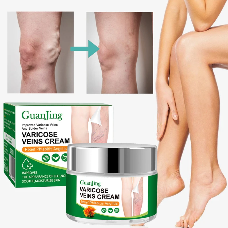 

Effective Varicose Veins Cream Vasculitis Phlebitis Spider Pain Vessel Legs Treatment Relief Ointment Body Care Capillary Health