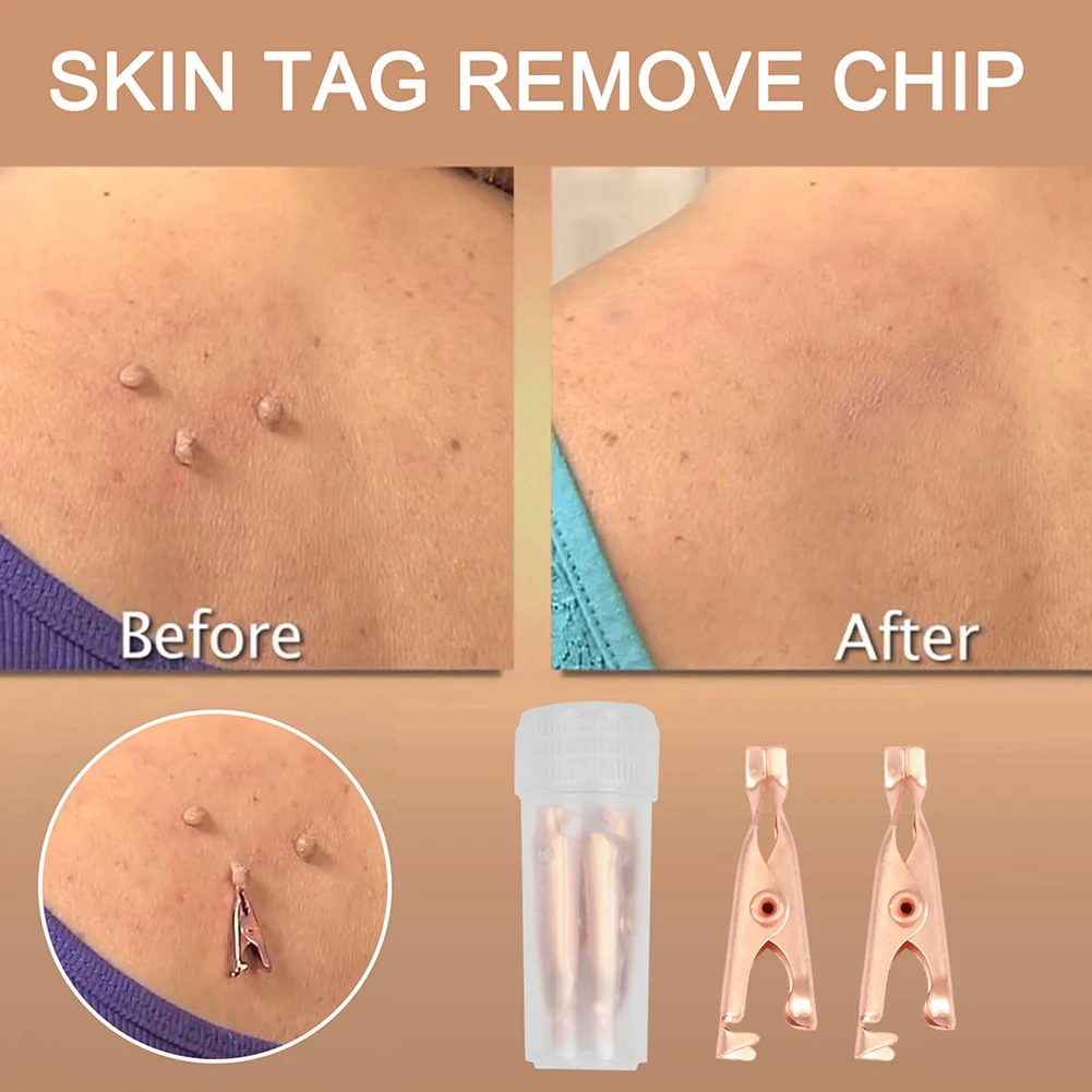 2/6 шт. безболезненная бирка для кожи клипсы удаления родинок бородавок лечение