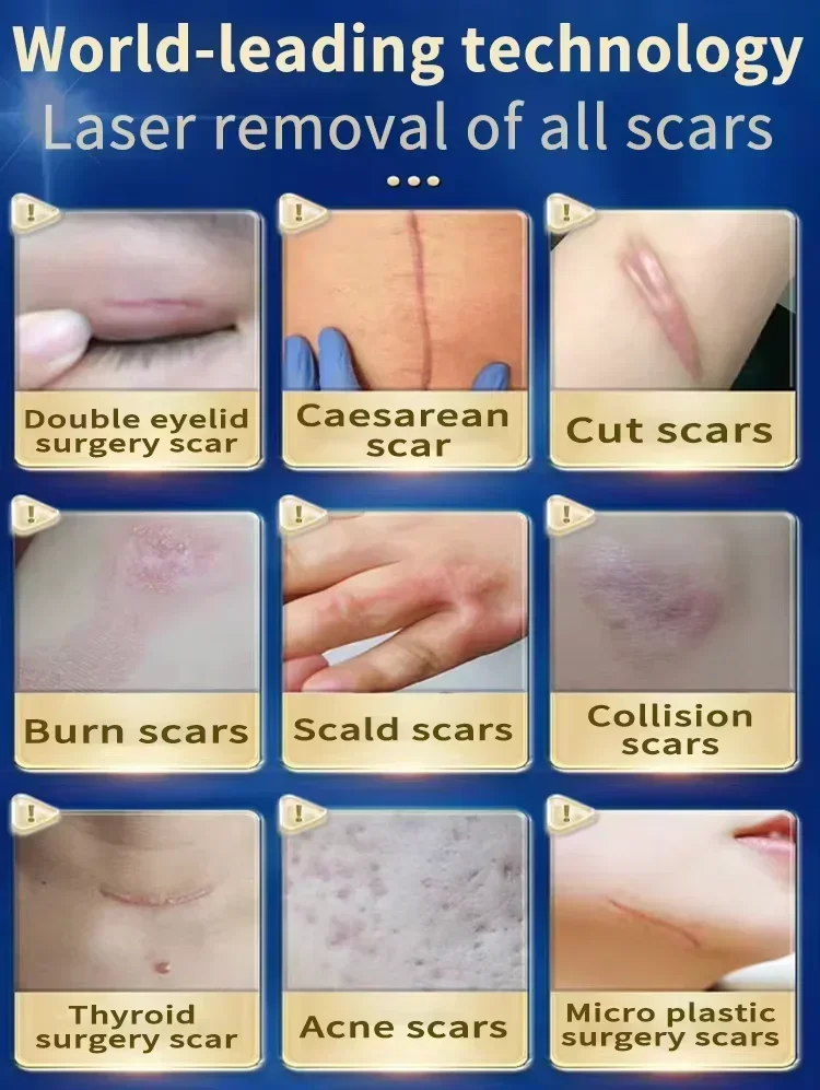 Лазерная терапия Keloid scAR