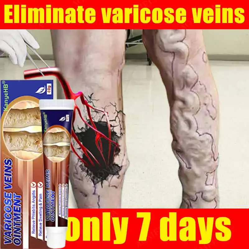 

Effective Varicose Vein Relief Cream Eliminate Vasculitis Phlebitis Spider Legs Treatment Soothing Relieve Pain Herbal Ointment
