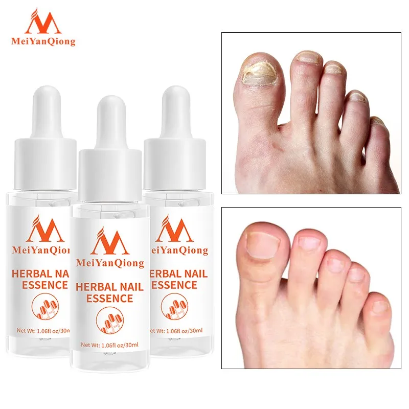 

3 шт., эссенция для ухода за ногтями и лечения Ногтей