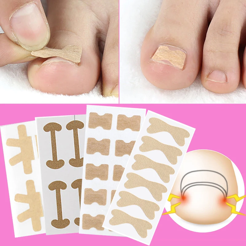 

Sdotter 4-20PCS Toe Nail Correction Stickers Ingrown Toenail Corrector Patches Paronychia Treatment Recover Corrector Pedicure T