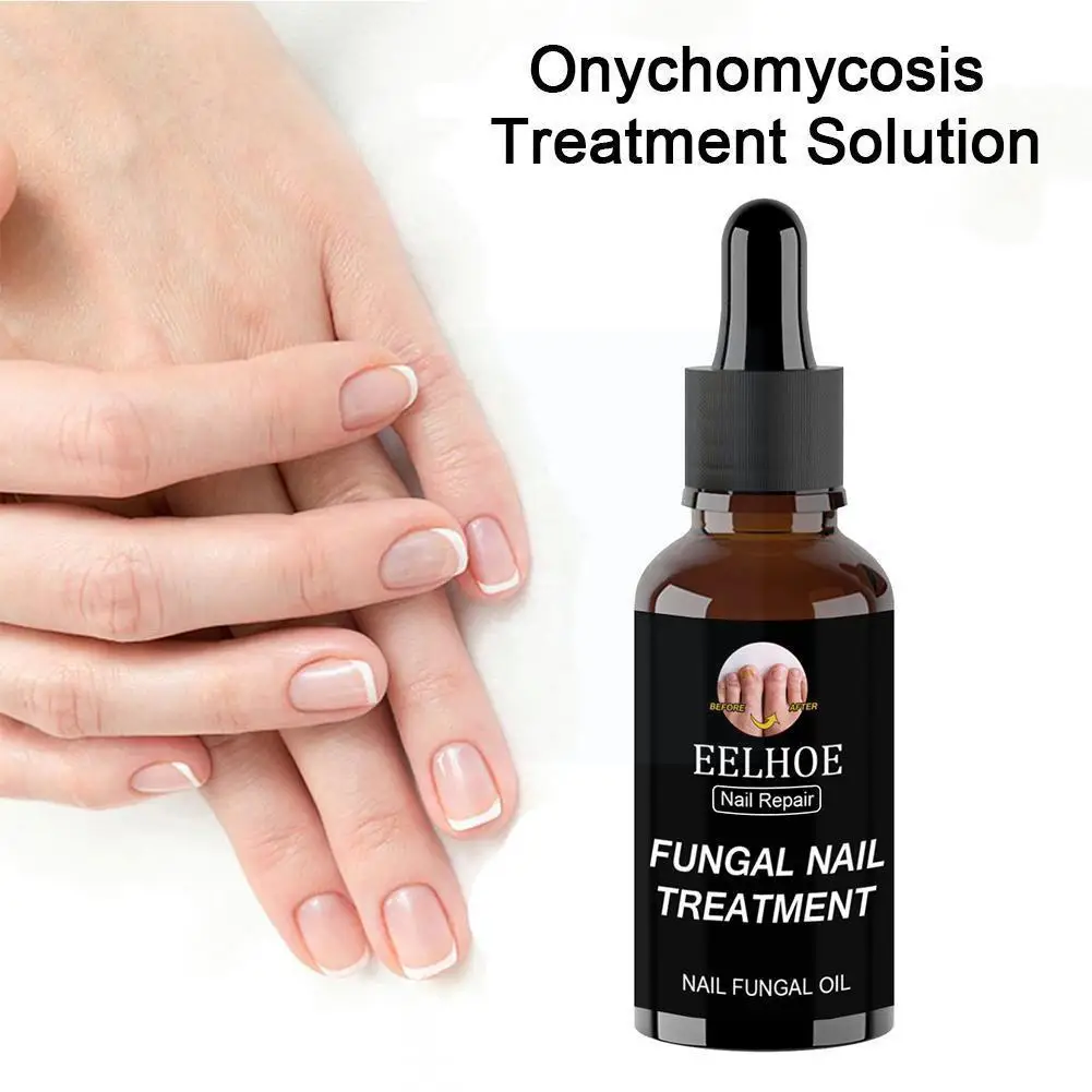 30ml Fast Fungal Nail Treatments Serum Anti-fungal Essences Fungus Paronychia Repair Onychomycosis Nail Herb Foot Toe Sensi G2l4