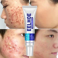 effective acne cream treatment pimple fades dark spots shrink pores oil control whitening moisturizing brighten gel face care