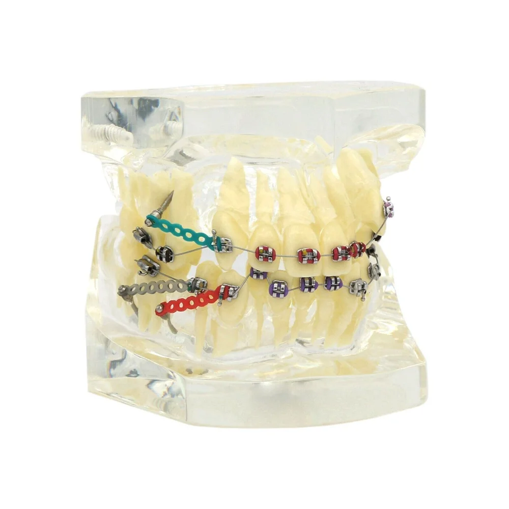 Dental Orthodontics Treatment Teeth Model with Metal Brackets Arch Wires Ties for Demonstrate