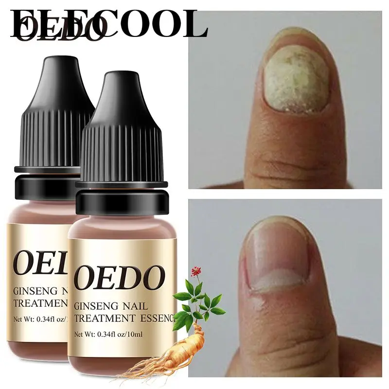 

Натуральное восстанавливающее эфирное масло, эффективное масло для ногтей, питательное антибактериальное масло для ногтей, противогрибковое масло