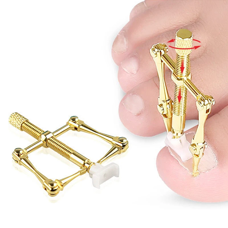 Набор медицинских корректирующих фиксаторов для вросших ногтей