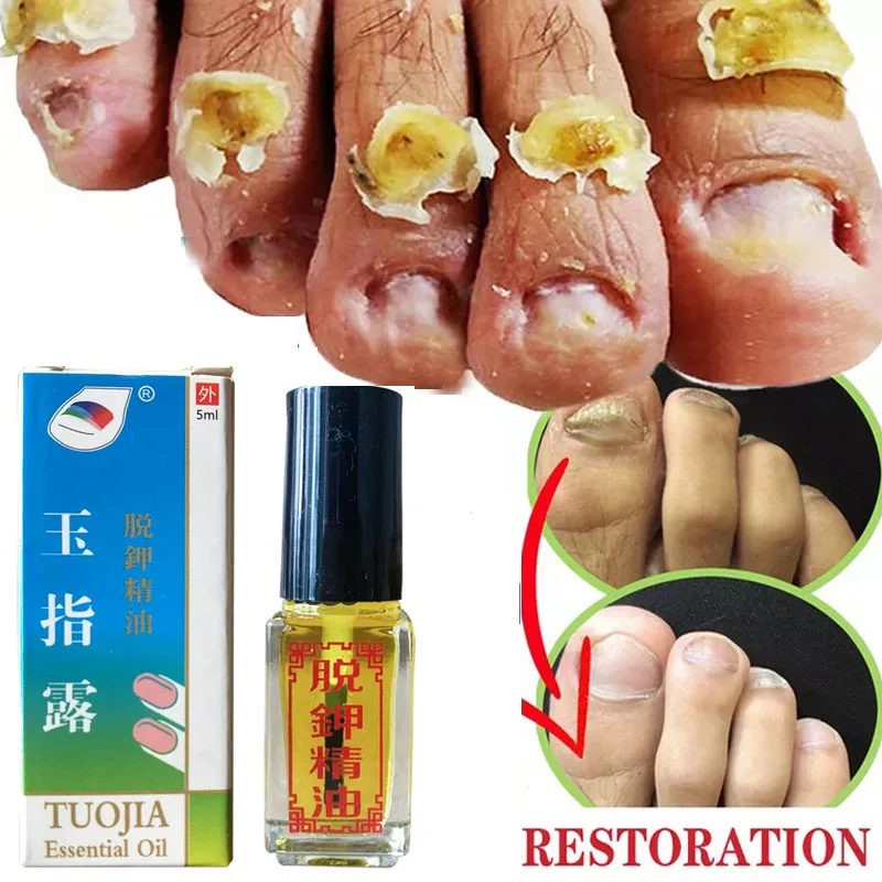 

Nail Fungal Treatment Essential Oil Anti Infection Remove Toe Nail Paronychia Onychomycosis Reapir Damaged Foot Care Products