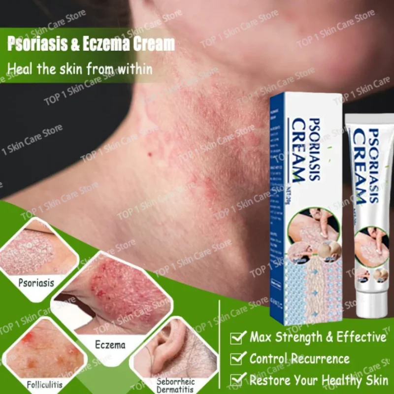 Натуральный растительный экстракт для удаления псориаза от дерматита