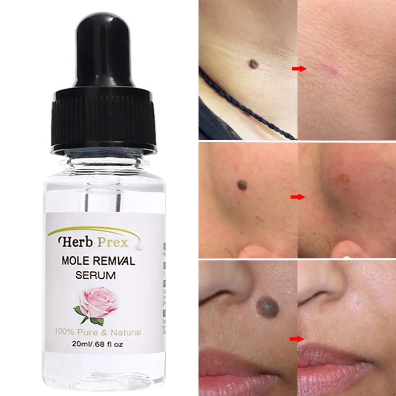 

Mole Wart Removal Liquid Natural Herbal Harmless Essence Oil Skin Tag Repair Solution Painless Face Wart Mole Treatment Serum