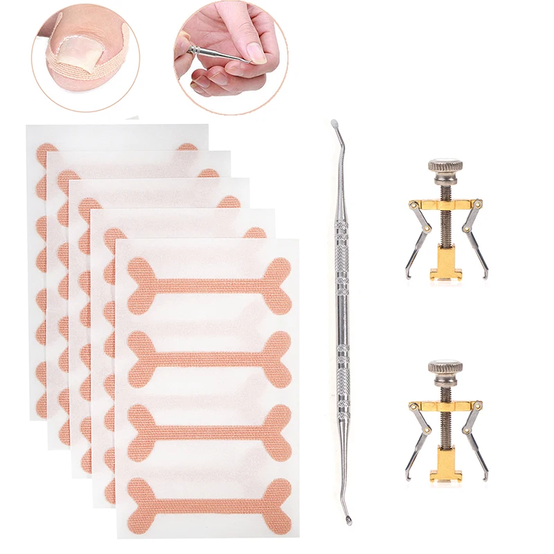 

Профессиональный фиксатор для вросших ног, средство для восстановления и коррекции кожи, инструмент для педикюра