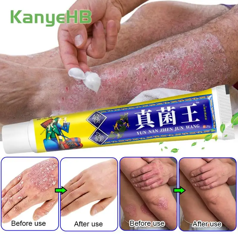 

1Pcs Psoriasis Cream Eczema Antibacterial Ointment Relieve Skin Itch Swell Remove Dermatitis Anti-Fungus Skin Care Cream S099