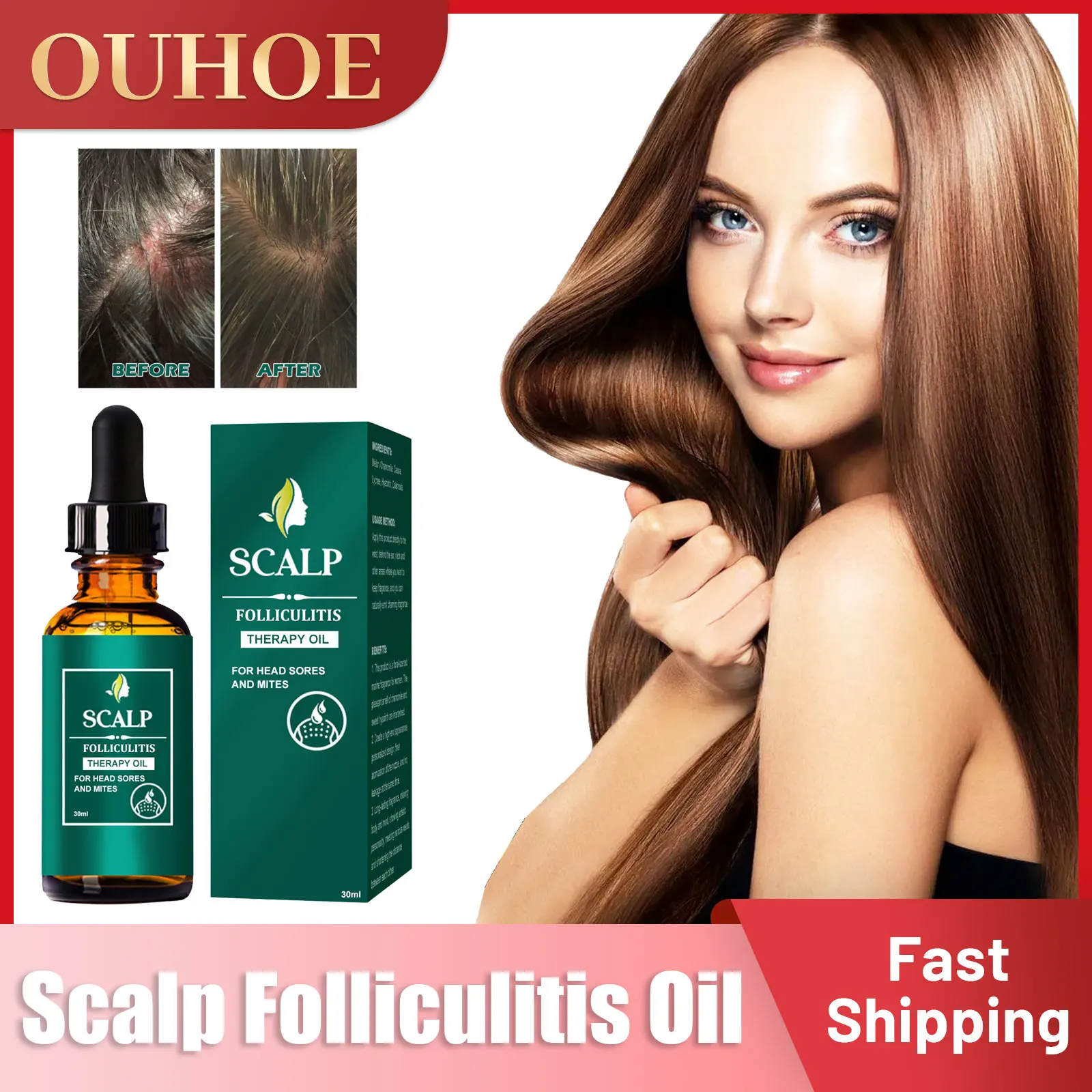 

Scalp Folliculitis Oil Remove Mites Oil Control Antibacterial Anti Itching Dandruff Scalp Treatment Psoriasis Hair Care Products