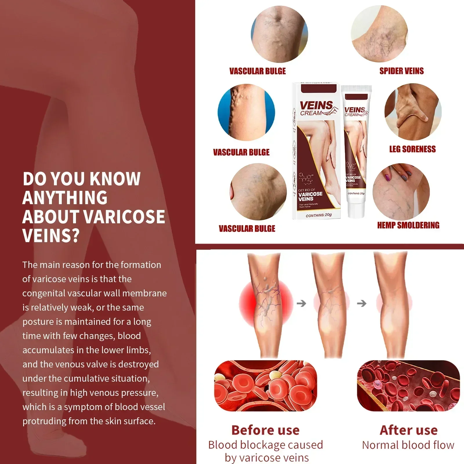 Varicose Vein Treatment Leg Health Ointment Effectively Removing Spider Veins2210