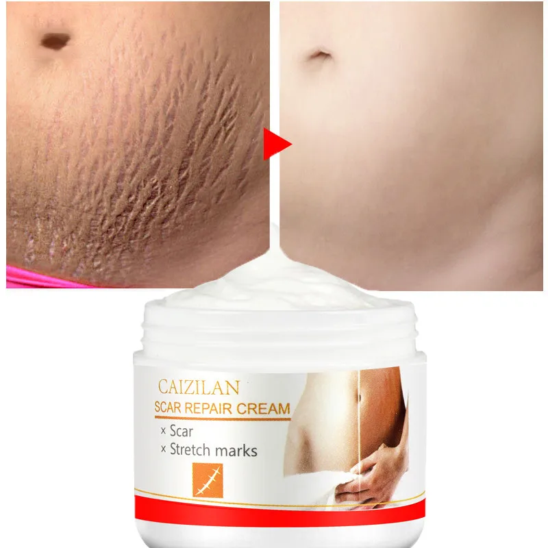 

Scar Repair Cream Acne Scars Remove Pregnant Women Skin Care Stretch Marks Removal Maternity Fat Striae Gravidarum Treatment 30g