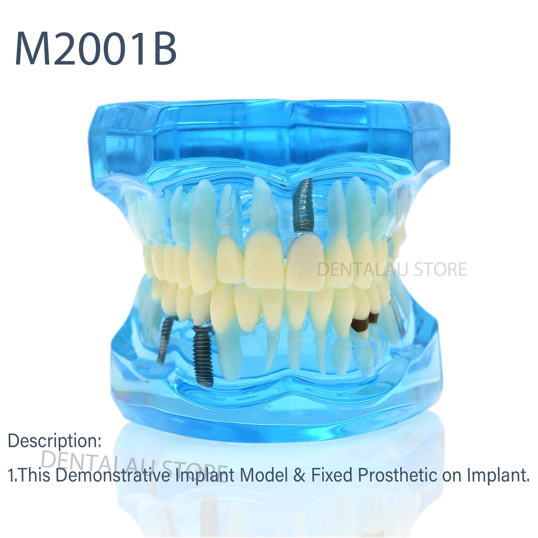 

Practice model M2001B blue Dental Implant Teeth Model Bridge Restoration Pathology Teach Study Demo for Schools and Colleges