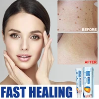 20g moles scars wart remove cream natural herbal anti acne face neck care verrucous skin dark spot wart treatment ointment cream