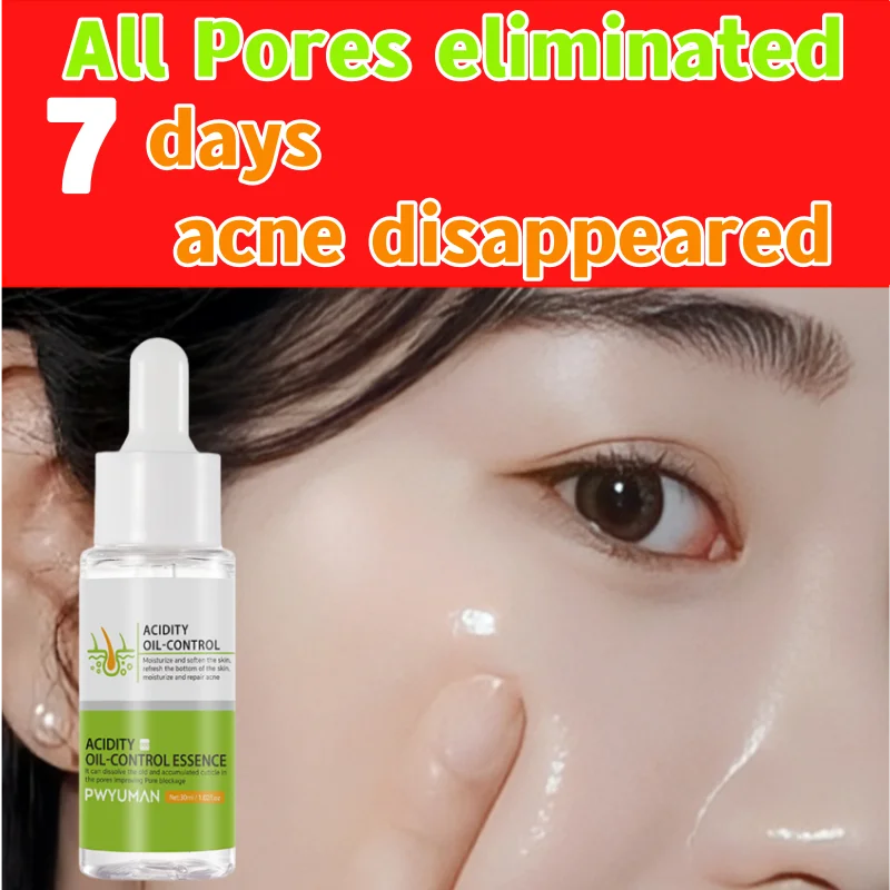 

Fruit Acid Anti-Acne Serum Fade Acne Oil Control Spots Shrink Pores Smooth Skin Brightening Skin Anti Acne Essence Skin Care