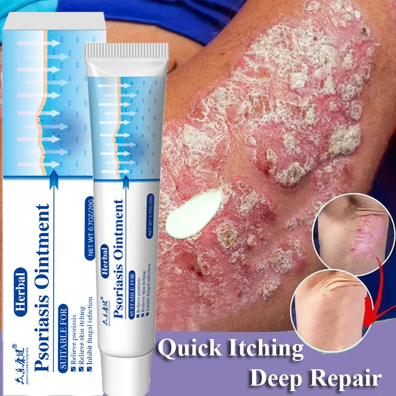 

Psoriasis Antibacterial Cream Dermatitis Eczematoid Eczema Ointment Anti-Itch Chinese Herb Medical Treatment Urticaria Skin Care