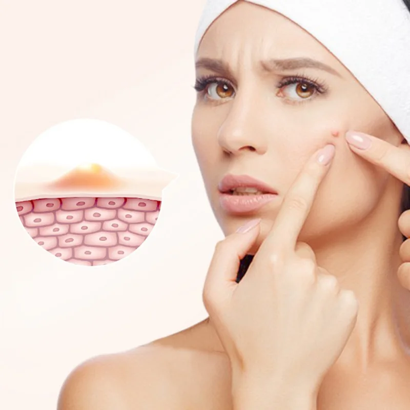 

Водонепроницаемые наклейки на прыщи от акне, средство для удаления прыщей и пятен