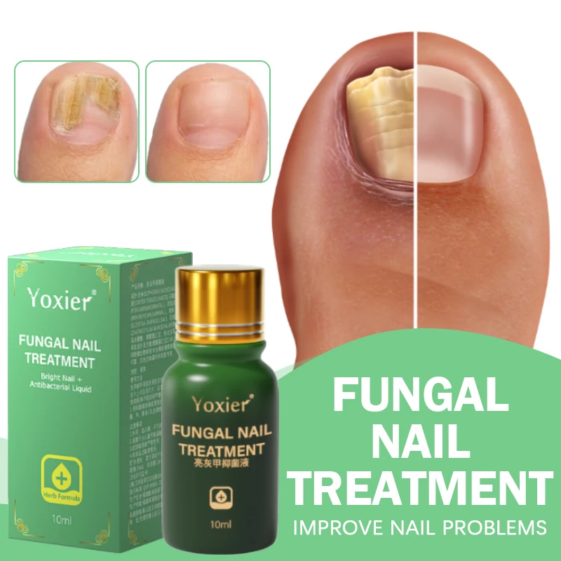 

Nail Fungus Treatment Serum Toe Foot Fungal Repair Products Hand Care Removal Gel Anti Infection Onychomycosis Paronychia
