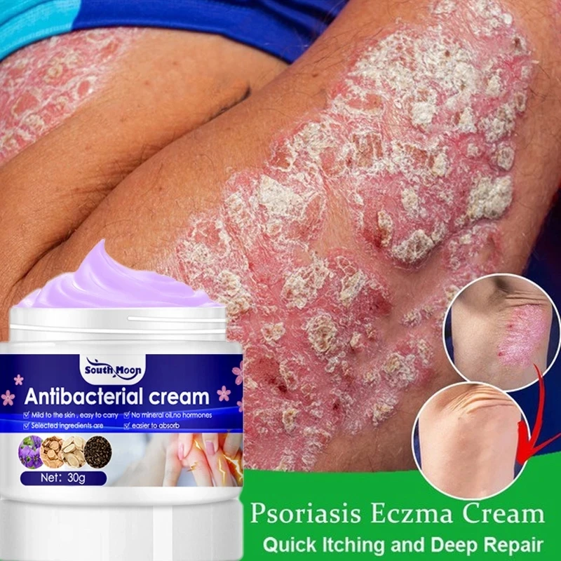 

Psoriasis Antibacterial Cream Dermatitis Eczematoid Ointment Effective Anti-Itch Chinese Herb Medical Health Skin Care Products