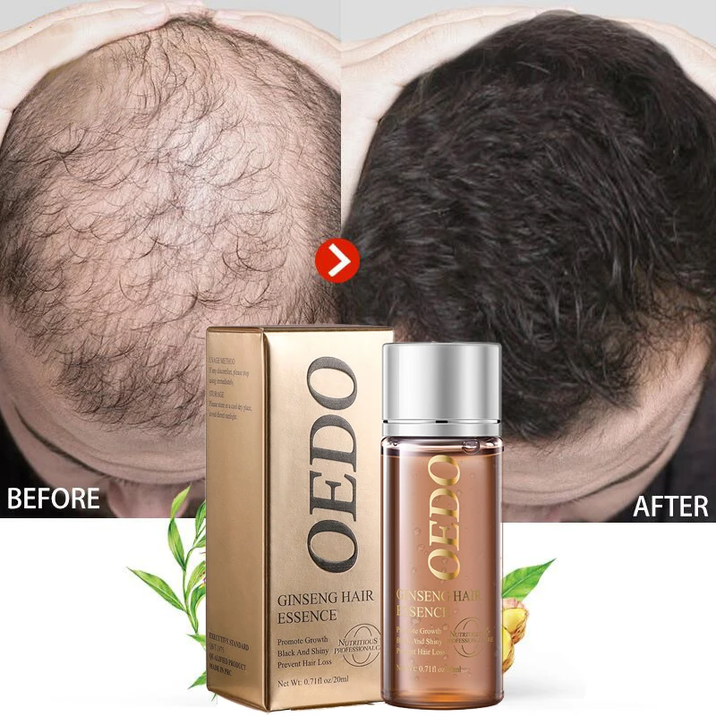 

Hair Growth Essential Oils Products Ginger Fast Growing Hair Anti Hair Loss Serum Prevent Baldness Treatment Liquid Men Women