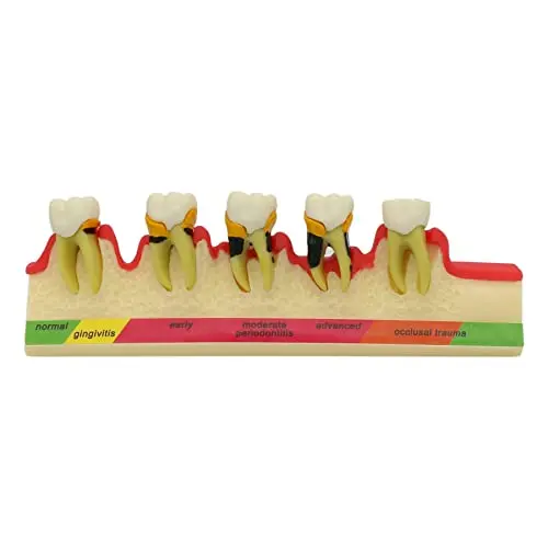 Dental Tooth Model - periodontal Disease Classification Model, Clearly displaying The periodontal Disease Process, Explaining