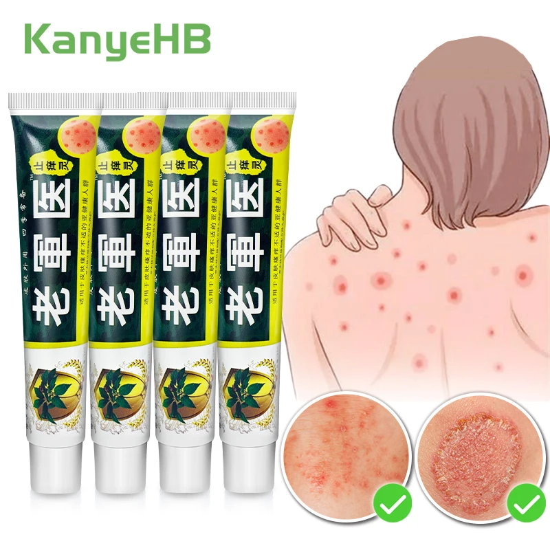 

1-2-4pc Herbal Medicine Dermatitis Cream Anti-itch Fungal Inhibition Psoriasis Plaster Eczema Cream Skin Disease Treatment Cream