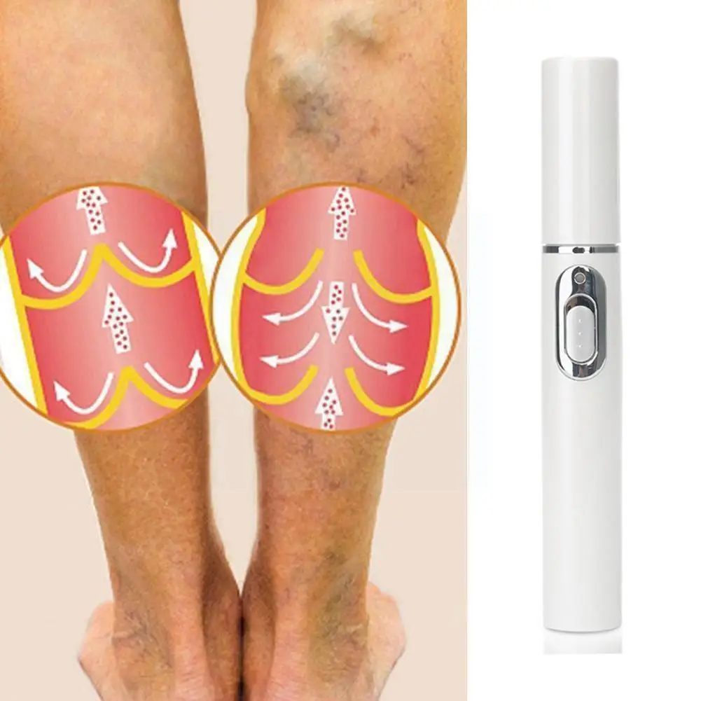 

1pc Medical Blue Light Therapy Pen Varicose Veins Treatment Scar Acne Removal Scar Soft Treatment I9T8