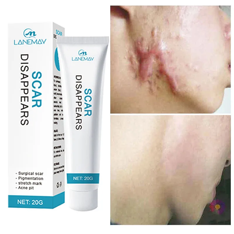 Scar Removal Cream Repair Stretch Marks Gel Burn Surgical Acne Scar Ointment Herbal Treatment Whitening Moisturizer Skin Care