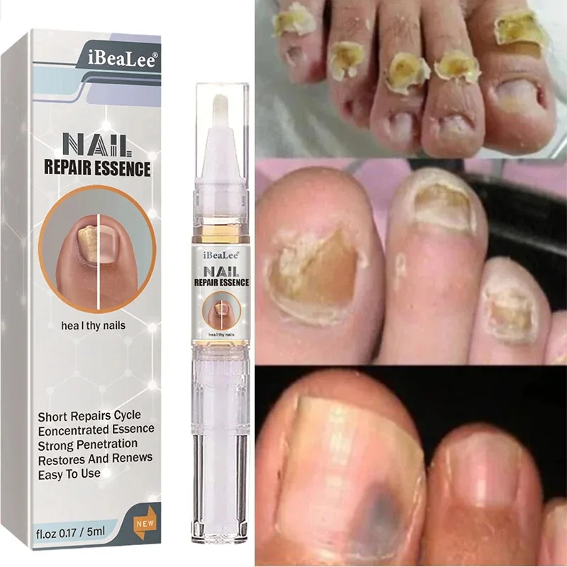 

Nail Fungal Treatment Essence Oil 7 Days Foot Repair Essence Toe Nail Fungus Removal Gel Anti Infection Fungal Nail Removal 5ml