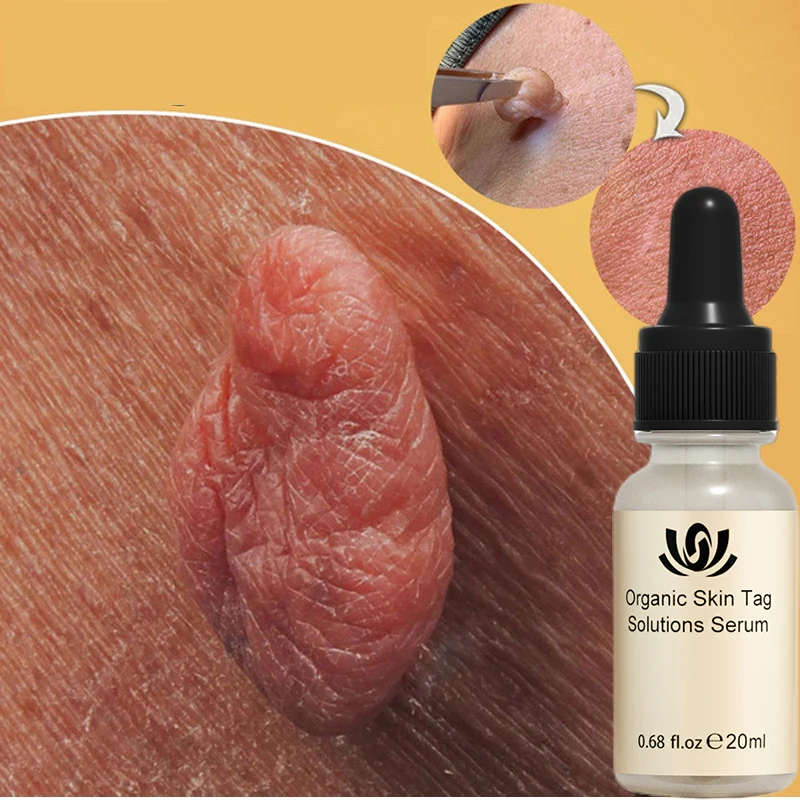 

Skin Tag Remover Essence Clean Painless Mole Skin Dark Spot Wart Remover Face Wart Tag Freckle Treatment Men Women Essential Oil