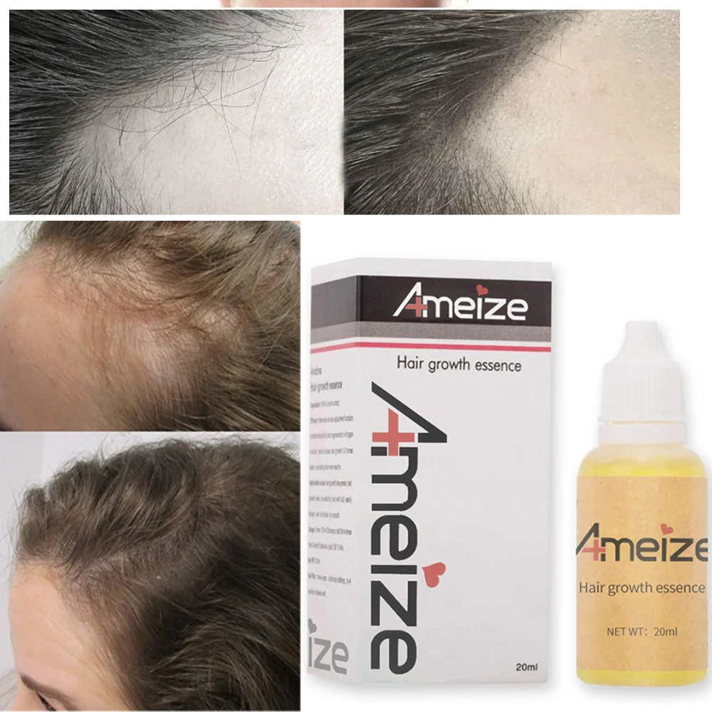 

Масло для роста волос, эффективное восстановление облысения и выпадения волос после родов