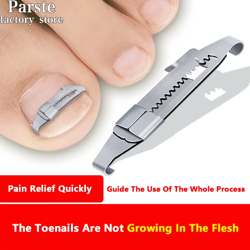 

Orthognathic Buckle Orthognathic Paste Toe Nail Groove Special Ingrown Nail Corrector Patch Toenail Fleshy Lilaritis Artifact