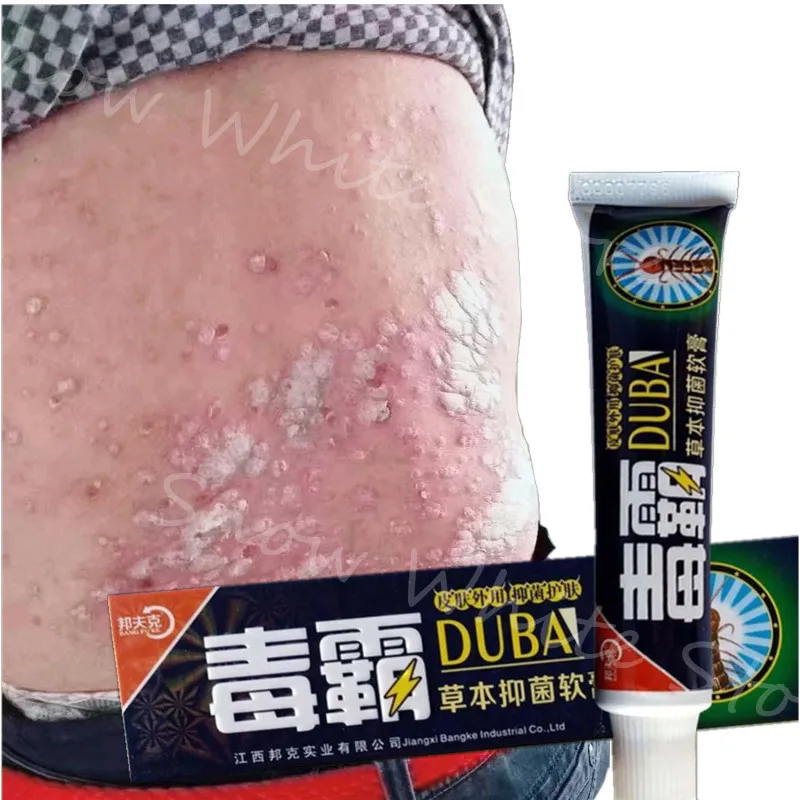 

5/10/20pcs Body Psoriasis Cream Perfect For Dermatitis and Eczema Pruritus Psoriasis Ointment Herbal Creams 15g